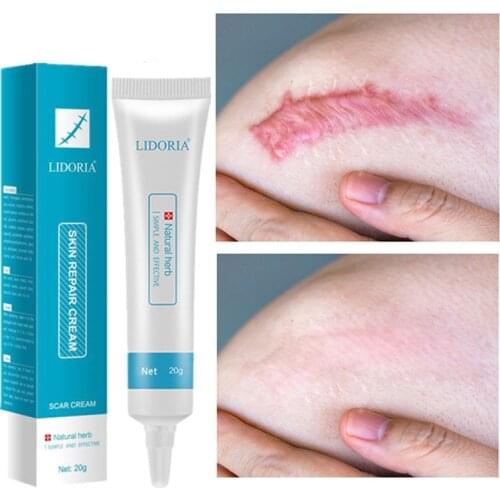 Scar Removal Cream Acne Scars Gel Stretch Marks Surgical Scar Burn For Body Pigmentation Corrector Acne Spots Repair Care 20g