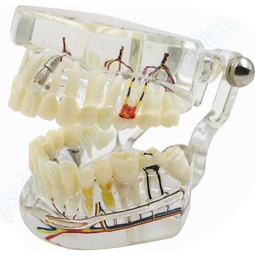 2018 new arrival dental teeth model Transparent pathological implant nerve model Repair model Teaching demonstration model