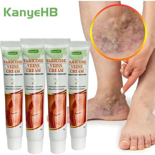 4pcs Treatment Varicose Veins Ointment Varicosity Angiitis Removal Vasculitis Phlebitis Spider Leg Pain Relieving Herbal Plaster