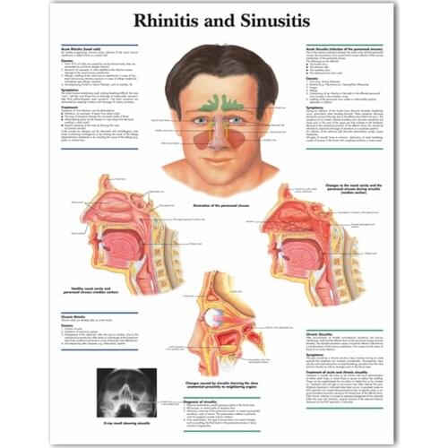 WANGART Medical Science Anatomy Rhinitis Sinusitis Chart Posters Canvas Print Wall Pictures for Medical Education Home Decor