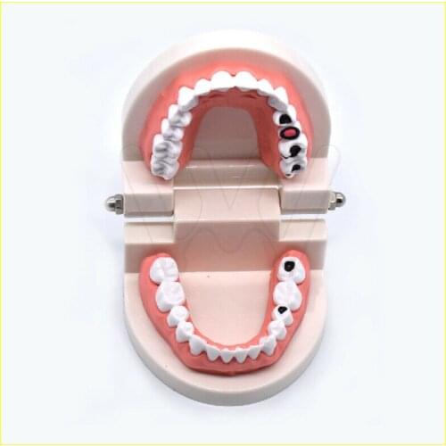 Dental Study Teaching Teeth Model Caries Tooth Care Education Dentist Equipment