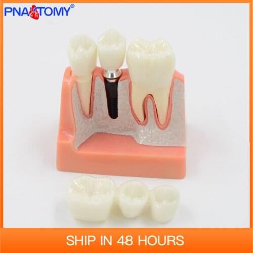Removable Dental Teeth Implant Restoration Model Pathological Nerve For Disease Analysis Demonstration Tool