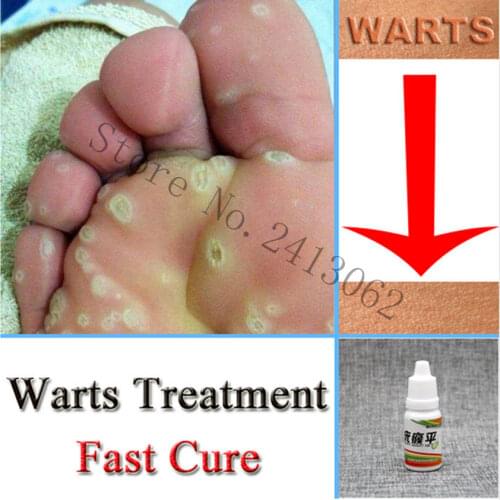 100% Natural Herbal Removing Flat Warts Filiform Unusual Fatty Lipid Particle Zoster Rash Shares Moss Liquid Wart Removal 10ml