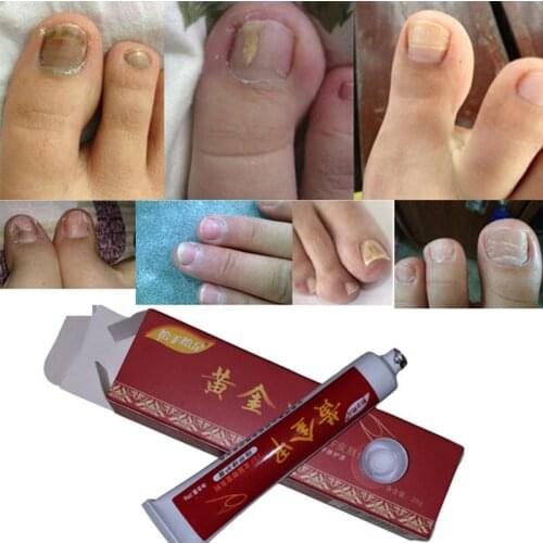 Chinese Medicine Plaster Nail Treatment Cream Onychomycosis Anti Fungal Nail Infection Fights Bacteria Naturally ointment