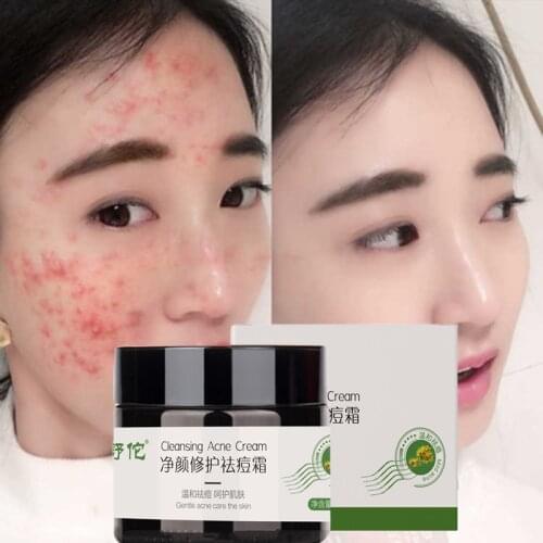 Acne Treatment Face Cream 30g Remove Melasma Acne Spots Pigment Melanin Dark Spots Blackhead Repair Herbal Skin Care Cosmetics