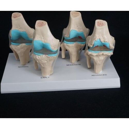 Anatomical Human Degenerative Knee Joint Disease Model Medical Skeleton Anatomy Teaching Resources