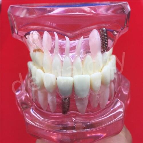 Dental Implant Disease Teeth Model With Restoration Bridge Tooth Dentist New
