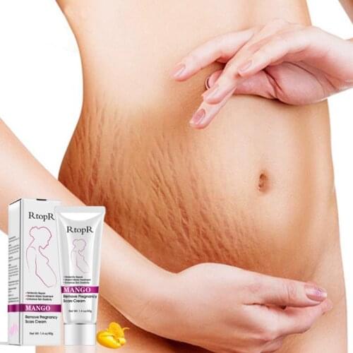 Hotsale Mango Remove Pregnancy Cream Scars Acne Marks Treatment Efficient Repair Health Maternity Skin Beauty Care