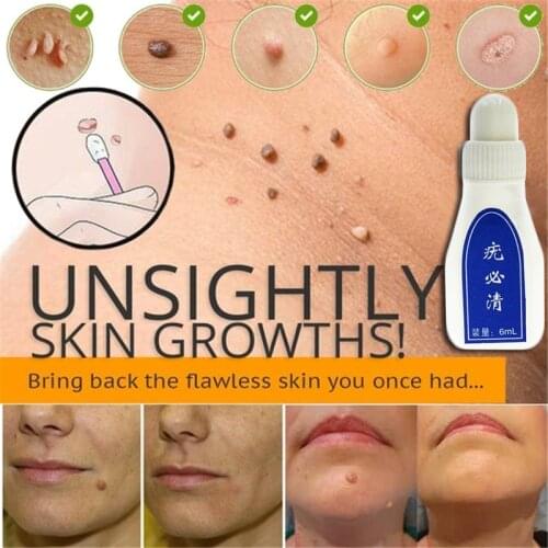 10ml Skin Tag Remover Chinese Medicine Body Warts Treatment Foot Corn Removal 12 Hours Remover Skin Tag Remover Foot Care