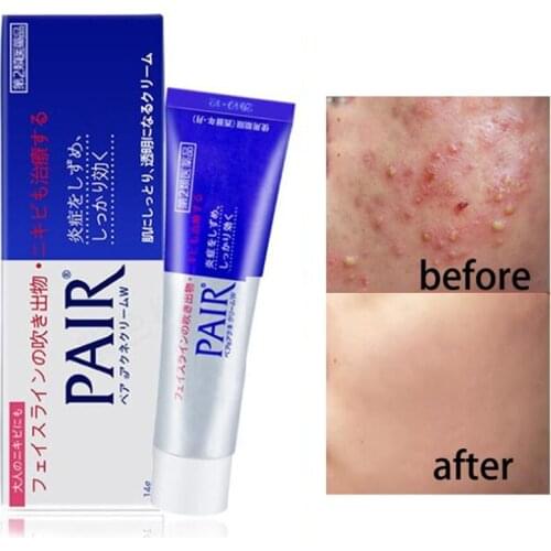 Japan Lion Pair Acne Cream Effective Acne Removal Cream Acne Treatment Fade Acne Spots Oil Control Shrink Pores Whitening Skin