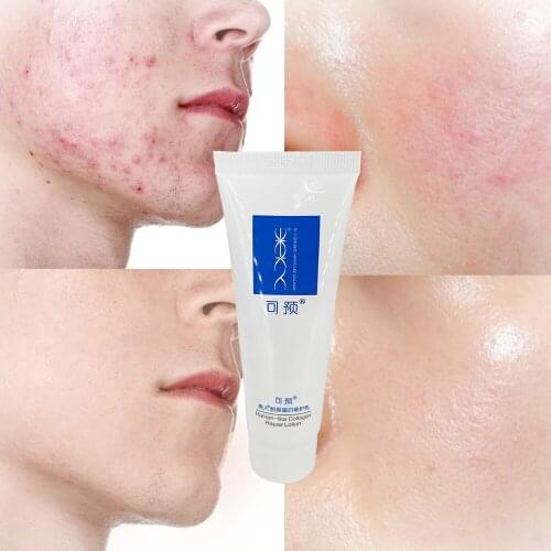 Human-Like Collagen Skin Repair Cream Light Print Scars Removal Moisturizing Acne Treatment Beauty Whitening Soothing Face Cream