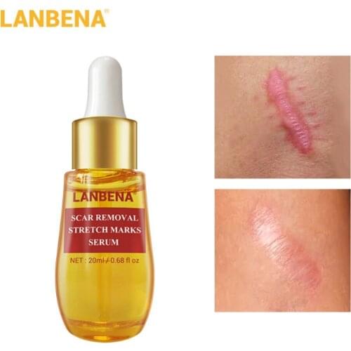 20ml Acne Scar Repair Face Serum Removal Acne Scar Whitening For Spots Acne Treatment Stretch Marks Skin Care