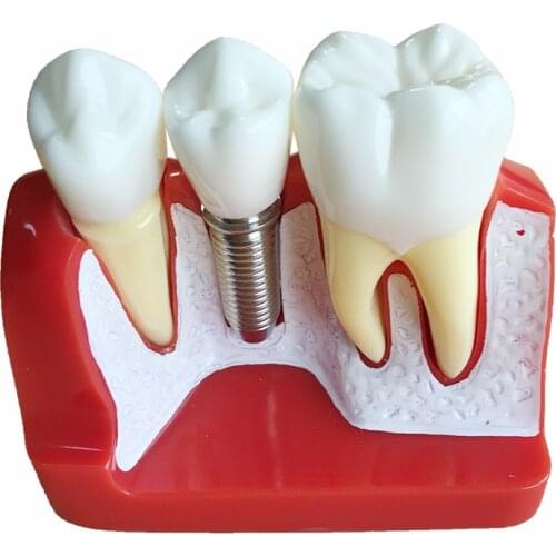 Dental Model Implant Analysis Model Demonstration Teeth Model Teaching Model Dentistry Products