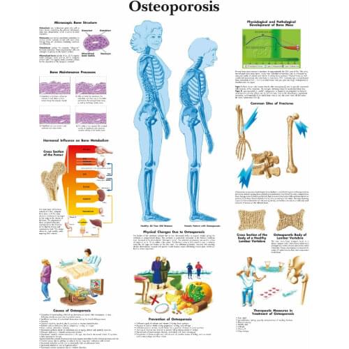 Osteoporosis Picture Art print Silk poster Home Wall Decor