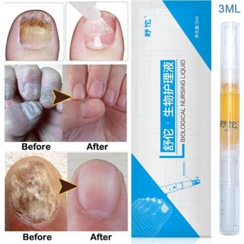 2021 new Anti-fungal Home Treatment Set Toe Nail Treatment Pen Onychomycosis Paronychia Anti Fungal Fungus Care Repair Serum Kit