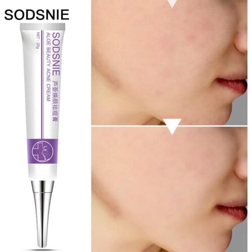 Face Cream Aloe Vera Gel Anti Acne Blackhead Removal Anti Acne Cream Oil Control Shrink Pores Scar Whitening Skin Care TSLM2