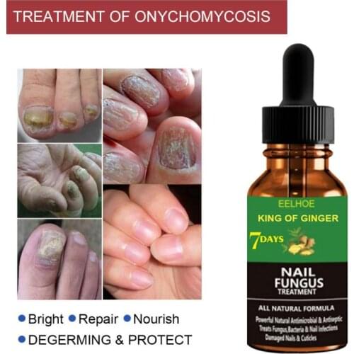Nail Repair Serum Anti Paronychia Onychomycosis Care Foot Nail Fungus Removal Repair Liquid Nail Care Foot Anti-fungal Health