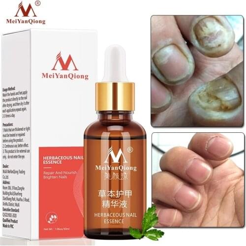 Nail Fungal Treatment Feet Care Essence Nail Foot Whitening Toe Nail Fungus Removal Gel Anti Infection Paronychia Onychomycosis