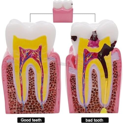 1Pcs Dental Teeth Model 6 Times Caries Comparation Study Denture Tooth Models Dentist Studying Researching Dentistry product