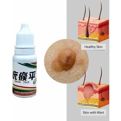 10ml Skin Tag Remover Wart Treatment Papillomas Removal Liquid Against Moles Remover Anti Verruca Remedy Ointment
