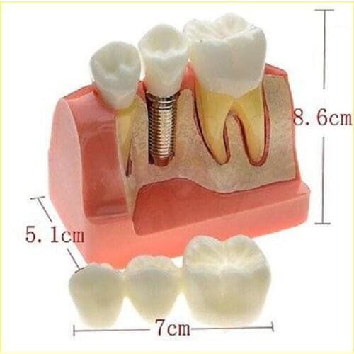 Dental Demonstration Teeth Model Implant Analysis Crown Bridge
