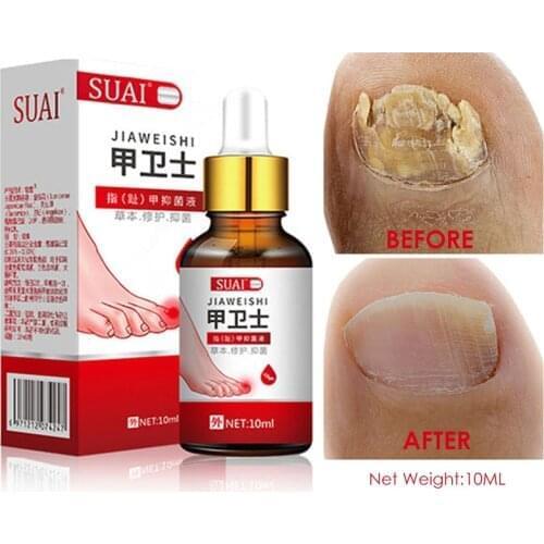 Nail Fungal Treatment Feet Care Essence Nail Foot Whitening Toe Nail Fungus Removal Gel Anti Infection Paronychia Onychomycosis