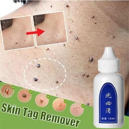 10ml Skin Tag Remover Chinese Medicine Body Warts Treatment Foot Corn Removal 12 Hours Remover Skin Tag Remover Foot Care