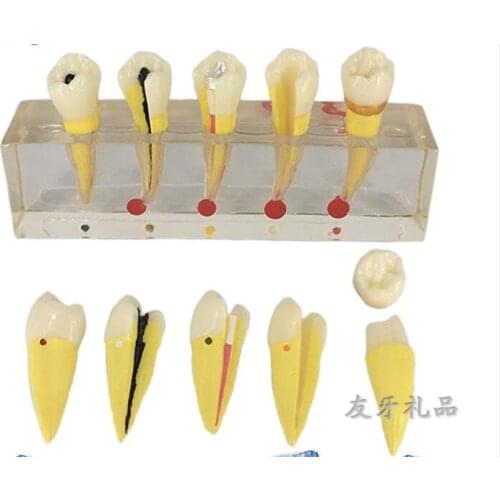 Tooth oral model dental endodontic clinical model dental Pathological demonstration model