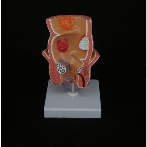 Anatomical Human Rectum Pathology Lesion Model Hemorrhoids Anus Medical Teaching Rectal Learning
