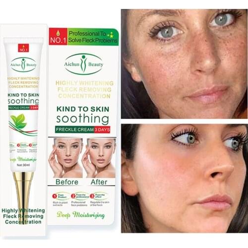 Effective Whitening Freckle Cream Gel Remove Melasma Acne Spot Pigment Melanin Dark Spots Pigmentation Moisturizing Skin Care