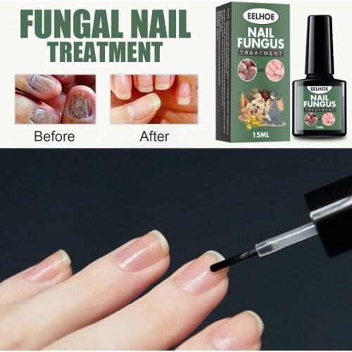 15ml Nail Fungus Treatment Care Nail Repair Toenail Essences Serum Nails Care Stop Fungal Growth Fingernail Treatments