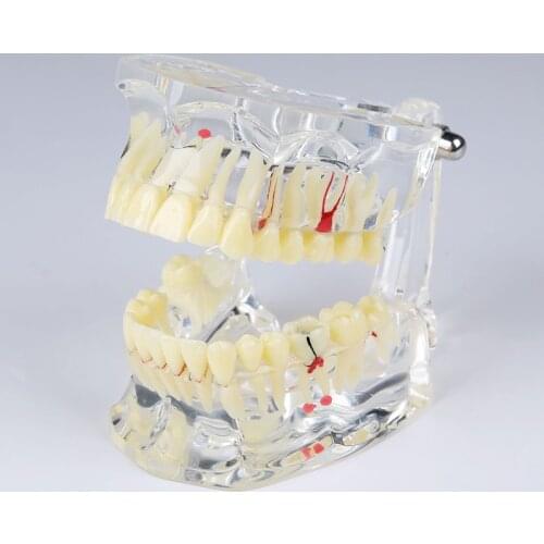 Adult pathological tooth model M4001/Adult pathological model/Orthodontic pathology demonstration model/Dental teeth model