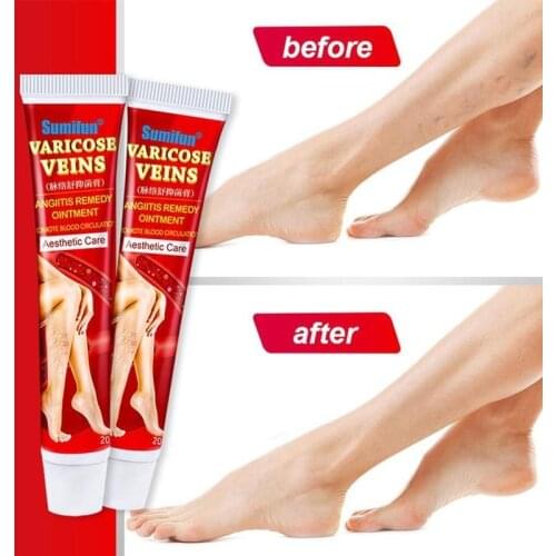 20g Chinese Varicose Vein Ointment Varicose Veins Treatment Cream Fast Relief Veins Pain Phlebitis Legs Varicose Veins Cream