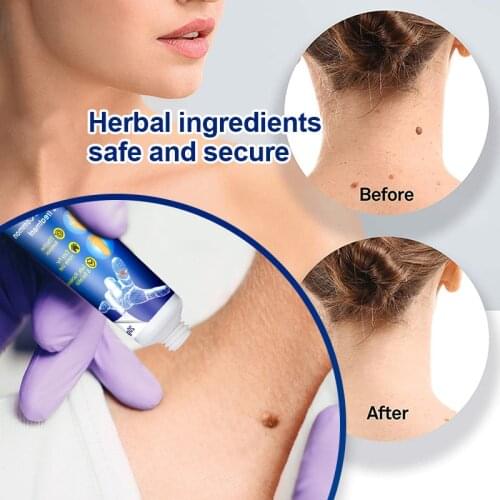 1/3pcs Instant Blemish Removal Gel Wart Removal Body Warts Treatment Cream Foot Care Cream Skin Tag Remover can CSV