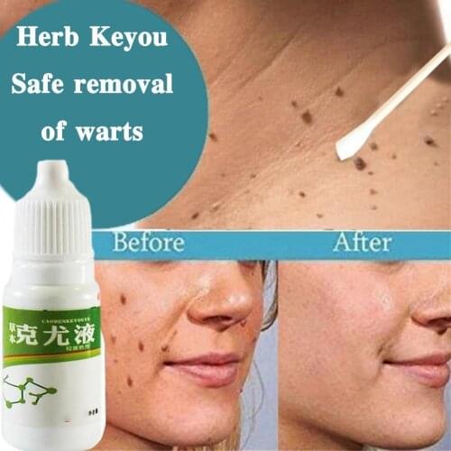 Genital Warts Treatment Papillomas Removal Warts Fluid Wart 10Ml Remedy Against Anti Remover Removal From Moles Skin Tags Remove