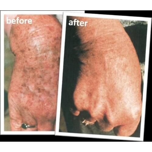 DropShipping Link Australia Superfade Body Cream for Dark Hormone Mark Age Spot Remover Pigment Spots Freckles Hyperpigmentation