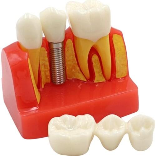 1pc Dental 4times Tooth Implant Model Analysis Crown Bridge Demonstration Teeth Model for Education with Removable Crowns