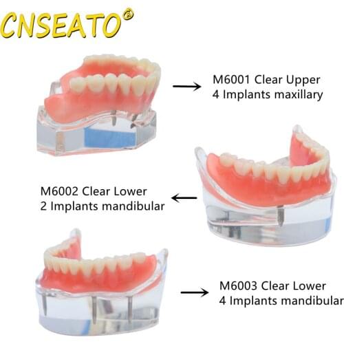 CNSEATO 1 PC Dental Implant Teeth Model Demo Overdenture Typodont Restoration Model 2/4 Implants Upper&Lower M6001