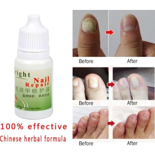 100% Really WORK Chinese Medicine Plaster Nail Fungus Treatment Cream Kills 99.9% Bacteria and Fungal Nail Onychomycosis Anti