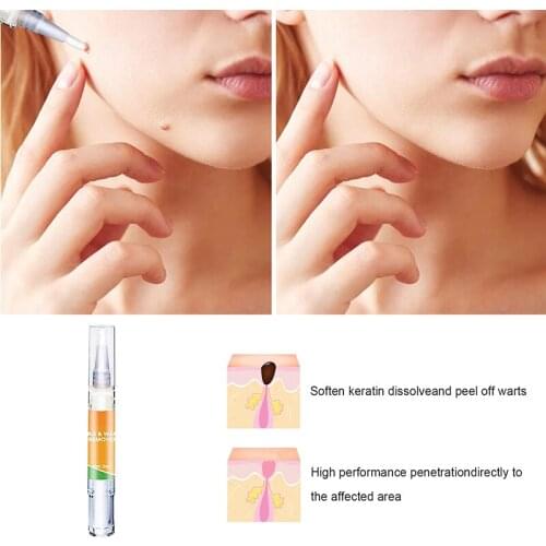 Tags and Moles Remover Removes Skin Tag and Moles Gently Rejuvenate Skin A7