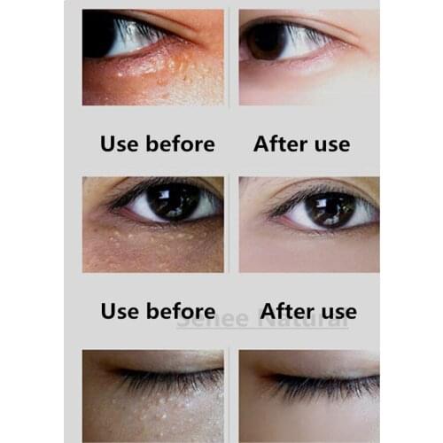 Herbal Eye Essence Extract Fat Granules Eye Swelling Remove Bags Eyes Dark Circles Fine Lines Eye Care Serum Beauty Salon 1kg