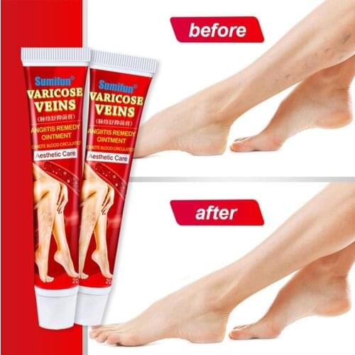 20g New Varicose Veins Treatment Cream 100% Original Vasculitis Phlebitis Ointment Spider Medical Plaster Pain Relief M3W8