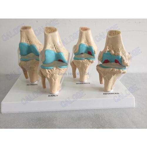Special deals are on sale&Human knee joint disease model, bone tissue,four stage, Department of orthopedics model medical