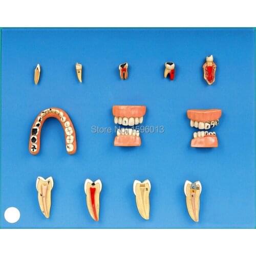 Dental Diseases Model, Lesions Series of Dental model