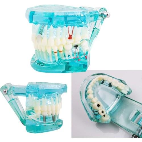 Dental Study Tooth Model Adult Pathological teaching Teeth model new denshine