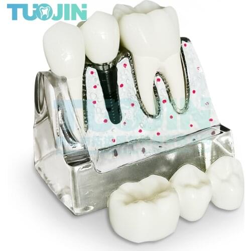 Removable Dental Teeth Implant Restoration Model Pathological Implant Nerve Model For Dental Disease Analysis Demonstration Tool