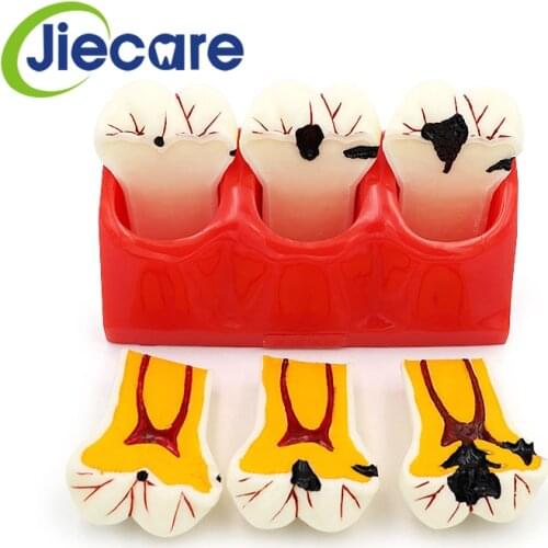 1PC Dental Denture Teeth Model Caries Disasscmbking Comparison Model Tooth Decay Model Dentist Pathologies For Medical Teaching