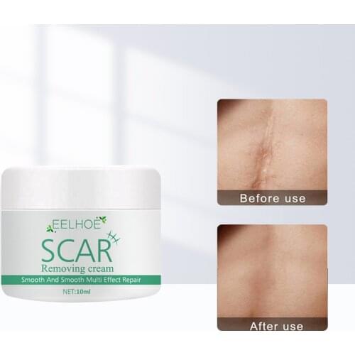 Acne Scar Removal Cream Gel Face Pimples Stretch Marks Cream Repairing Smoothing Whitening Moisturizing Body Cream Skin Care 10g