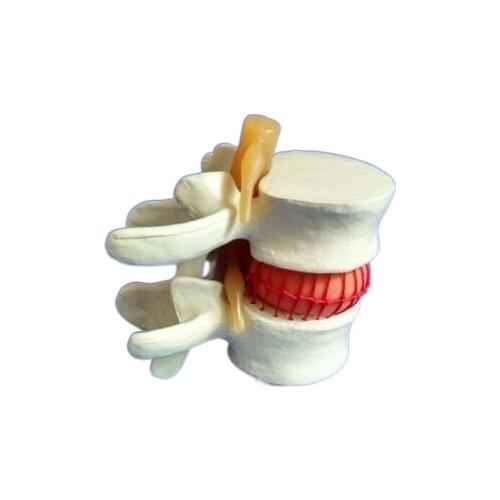 Intervertebral disc herniation model vertebral disc lesion model vertebral compression model human skeleton model