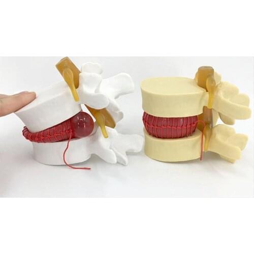 Lumbar disc herniation Human anatomy skeleton Spine model Teaching Model human spine vertebra pathology demonstration model